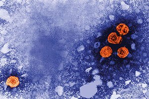 Hepatitis-B-Virionen (Viruspartikel) orange angefärbt;  elektronenmikroskopische Aufnahme
