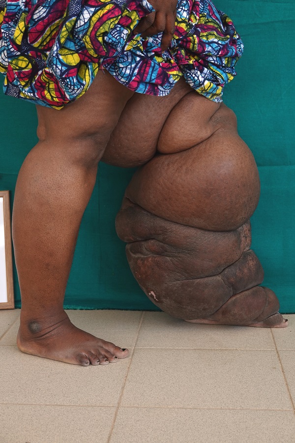 In Cameroon a special form of lymphedema is widespread: Like lymphatic filariasis, podoconiosis causes grotesque swellings particularly in the feet and legs. In addition to physical complaints it incurs a great deal of mental suffering.
