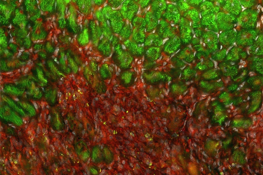 Mikroskopische Aufnahme von Herzgewebe nach einem Infarkt mit einem nicht optimalen Heilungsprozess. Die Aufnahme zeigt funktionsfähige Herzmuskelzellen (grün) sowie durch den Infarkt entstandenes Narbengewebe (rot).