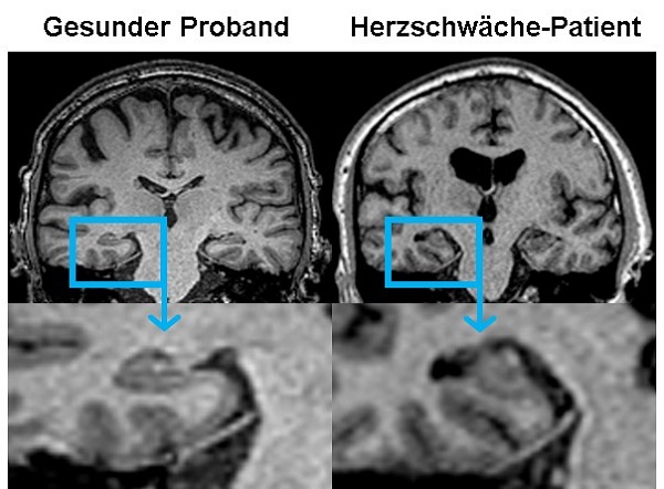 Links zeigt ein MRT-Bild das Gehirn von gesunden Probanden, rechts zeigt das Bild den Gewebeschwund bei Herzschwäche-Patienten.