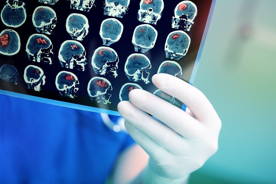 Mediziner betrachtet radiologische Aufnahme mehrerer Gehirnregionen nach einem Schlaganfall