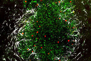 Mikroskopische Aufnahmen eines Glioblastoms im Gehirn einer Maus