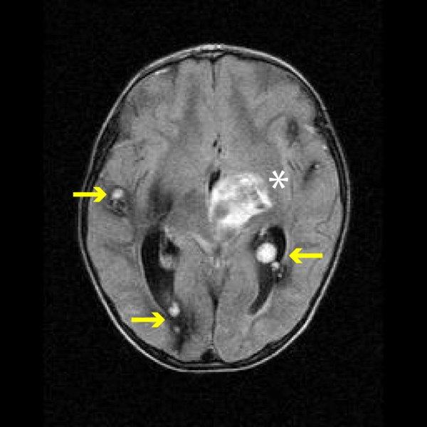 MRT Aufnahme eines Gehirns