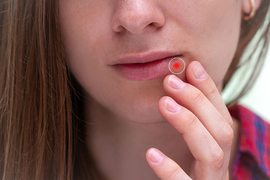 Junge Frau leidet an Herpes an der Lippe