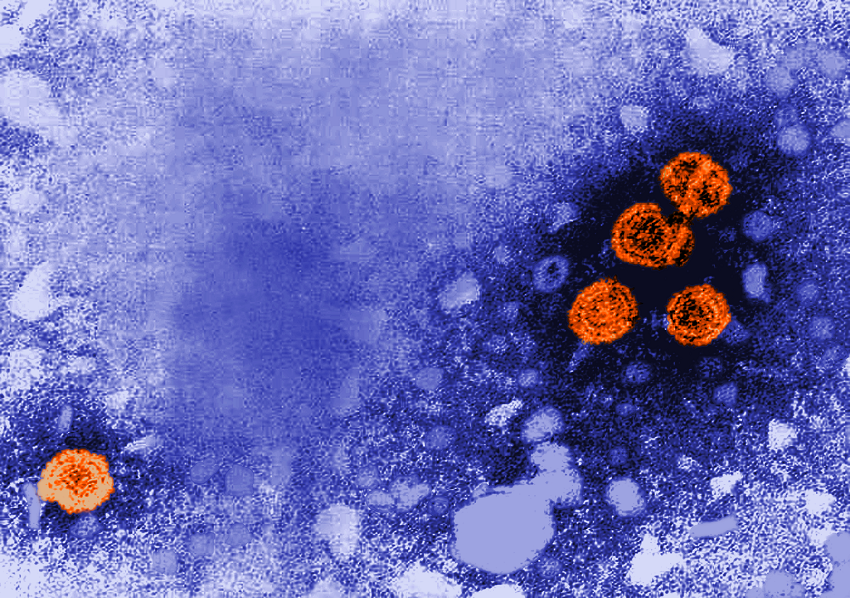 Hepatitis-B-Virionen (Viruspartikel) orange angefärbt; elektronenmikroskopische Aufnahme