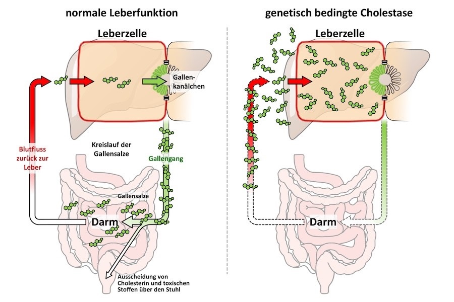 Schematische Darstellung des Gallensalzkreislaufes. Links bei normaler Leberfunktion, rechts bei genetisch bedingter Cholestase. 