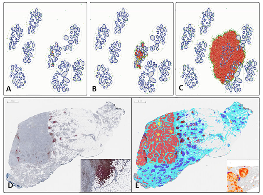 Grafische Darstellung einer Computersimulation aus der Krebsforschung in fünf Einzelbildern. Abgebildet wird die Interaktion zwischen Immunzellen und dem umliegenden Gewebe.