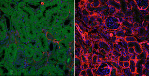 Nierengewebe unter dem Mikroskop: links das Gewebe einer gesunden Niere, rechts krankhaft verändertes Nierengewebe. Die Vernarbungen sind an der roten Anfärbung zu erkennen.