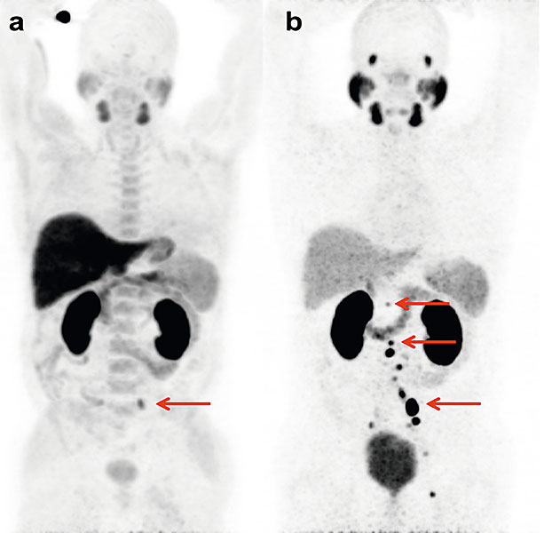 Empfindlicher Nachweis mit 68Ga-PSMA-PET: Mit der 68Ga-PSMAPET- Methode (rechts) werden deutlich mehr Lymphknotenmetastasen erkannt (rote Pfeile) als mit der üblichen 18F-Cholin-PET-Methode (links).