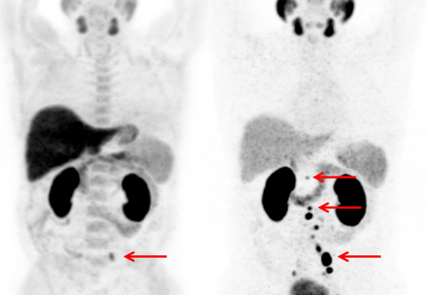  Empfindlicher Nachweis mit 68Ga-PSMA-PET: Mit der 68Ga-PSMAPET- Methode (rechts) werden deutlich mehr Lymphknotenmetastasen erkannt (rote Pfeile) als mit der üblichen 18F-Cholin-PET-Methode (links). 
