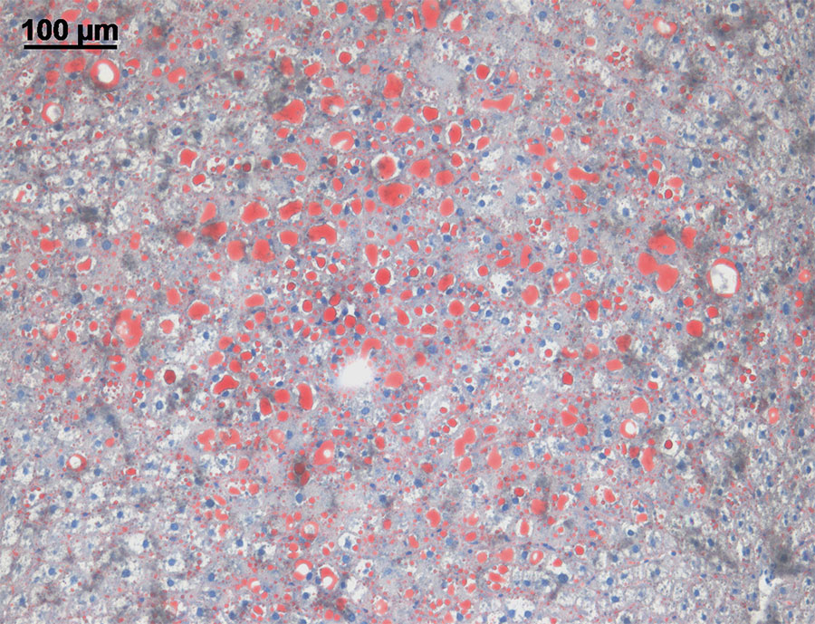 Mikroskopische Aufnahme von Leberzellen. Die Fetteinschlüsse sind rot dargestellt.