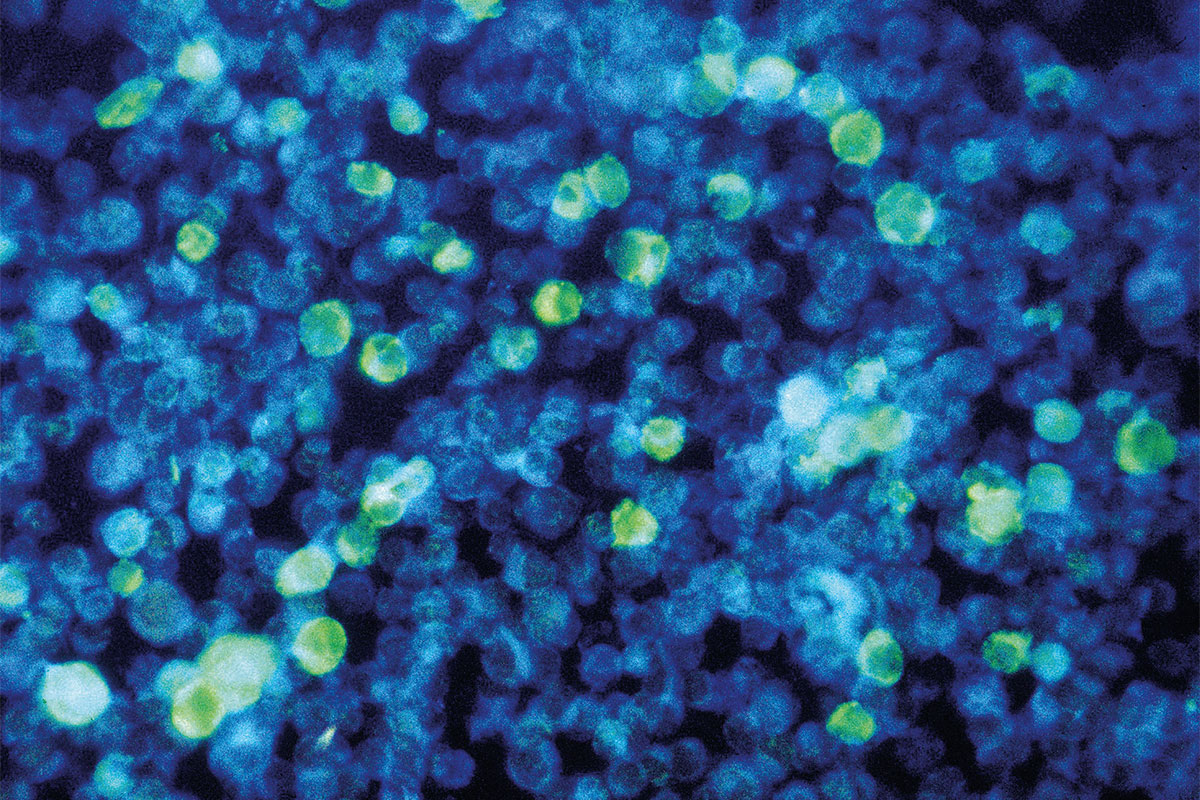 Das Epstein-Barr-Virus, hier in Leukämiezellen grün angefärbt