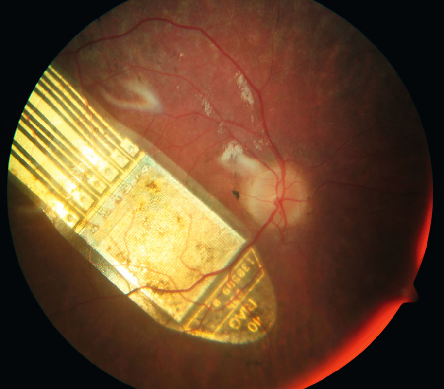 Der Netzhautchip misst dreimal drei Millimeter, nicht größer als ein Streichholzkopf. Er wird dem Erblindeten ins Auge implantiert.