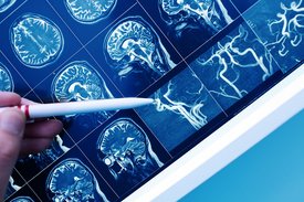 Arzt zeigt mit Stift auf das Blutgefäß des Gehirns auf dem MRT-Bild