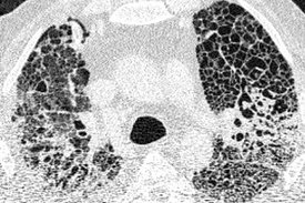 Computertomographie-Aufnahme (CT-Bild) der Lunge eines Patienten mit COVID-19-Lungenversagen. Helle Bereiche zeigen Verdichtungen und Vernarbungen des Lungengewebes.