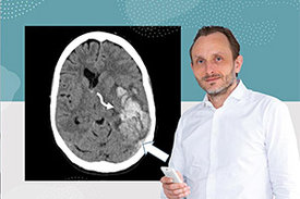 Professor Dr. Andreas Tiede mit der computertomographischen Aufnahme einer VITT-Patientin. Der weiße Pfeil deutet auf eine Hirnthrombose (hellgrau)