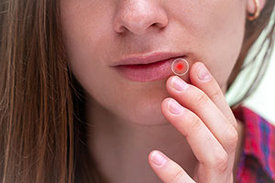 Junge Frau leidet an Herpes an der Lippe