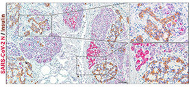 Gewebeschnitt aus dem Pankreas eines COVID-19 Verstorbenen, zwei Bereich wurden vergrößert (rechts): Insulin wurde in braun angefärbt, zeigt also die Beta-Zellen, die in den Langerhans-Inseln sitzen. In pink wurde ein SARS-CoV-2-Protein angefärbt.