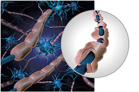 Grafische Darstellung des Abbaus des Schutzmantels um Nervenzellen bei Multipler Sklerose.                