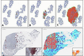 Grafische Darstellung einer Computersimulation aus der Krebsforschung in fünf Einzelbildern. Abgebildet wird die Interaktion zwischen Immunzellen und dem umliegenden Gewebe.