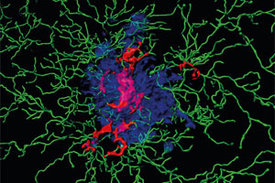 Ablagerungen im Gehirn: Dargestellt sind Entzündungsproteine (sogenannte ASC Specks, rot) im Kern einer Ansammlung von Amyloid-Beta-Peptiden (blau) sowie Immunzellen (grün).