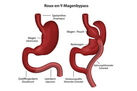 Schematische Darstellung einer Magen-Bypass Operation 