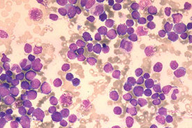 Bei der akuten lymphoblastischen Leukämie (ALL) entarten weiße Blutzellen (im Bild dunkel eingefärbt). Als Folge wird die gesunde Blutbildung gestört, und es kann ein Mangel an roten Blutzellen, Blutblättchen und weißen Blutzellen auftreten.