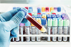 Der neue Bluttest soll den Krebs aufspüren, bevor andere Diagnosemethoden greifen.