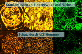 Sechs mikroskopische Aufnahmen von Nierengewebe. Oben drei Aufnahmen von ungeschütztem, vernarbtem Gewebe. Unten drei Aufnahmen von Gewebe, das durch ACE-Hemmer geschützt wurde. 