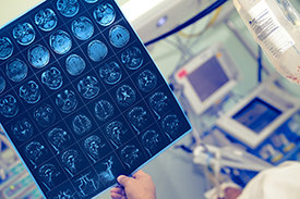 Personalisierte Schlaganfall-Therapie: Auch MRT- oder CT-Aufnahmen des Gehirns bezieht das Computermodell in die Analyse mit ein.
