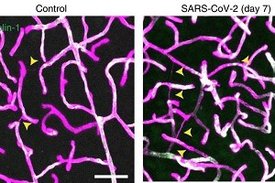 Nach Sars-CoV-2-Infektion findet man im Hirn häufiger abgestorbene Blutgefäße (gelbe Pfeile, Ergebnisse aus der Maus).