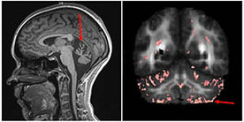 Zwei Aufnahmen von Gehirnen Betroffener, die einen Abbau von Nervenzellen im Klein- oder Großhirn zeigen. 