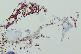 Entartete Plasmazellen aus dem Knochenmark eines Patienten mit Multiplem Myelom.